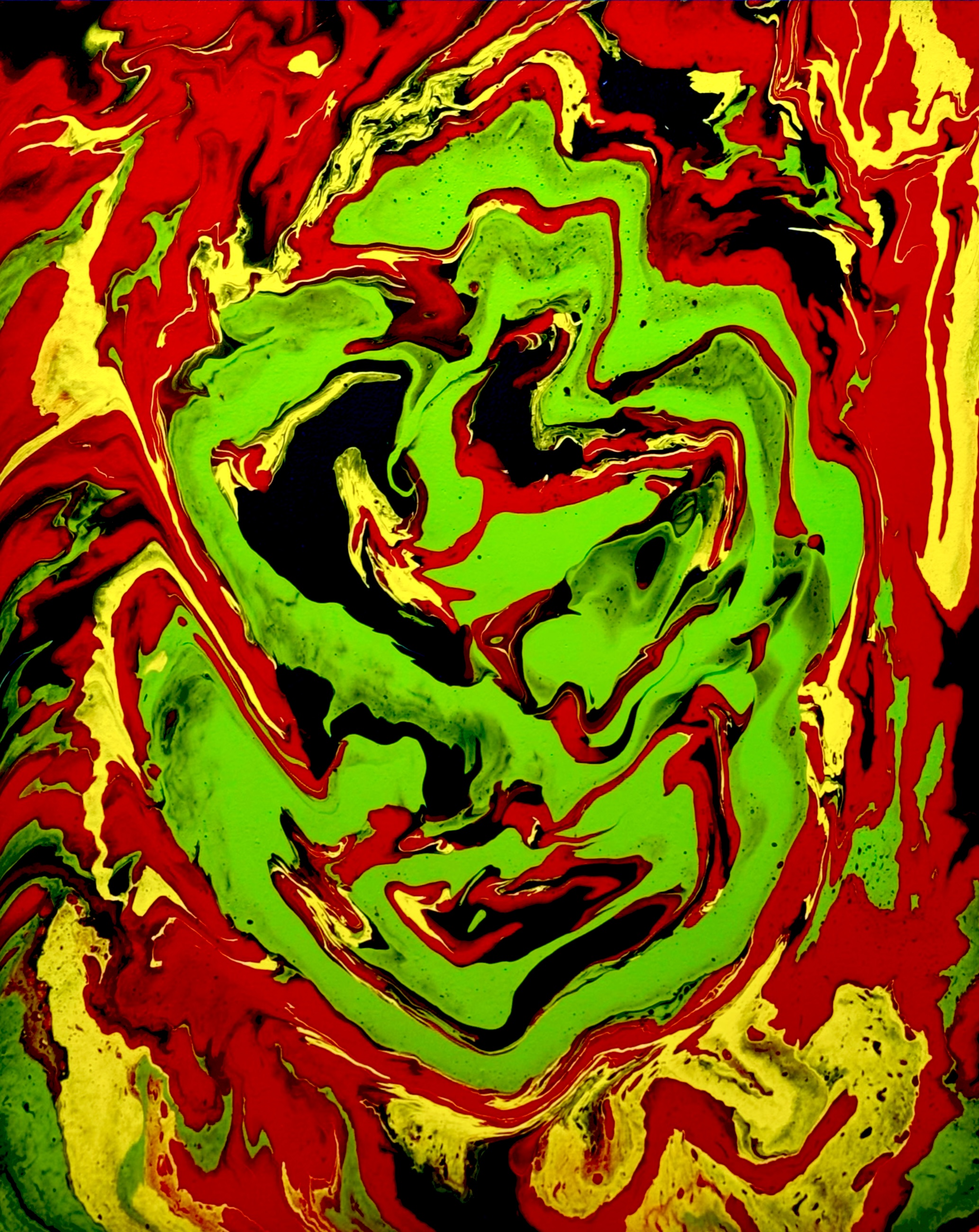 Migraine